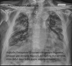 Η πνευμονία διάγνωση, πρόληψη και θεραπεία - Η ακτινογραφική απεικόνισής της 12